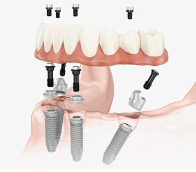 схема протезирования челюсти на 4 имплантах